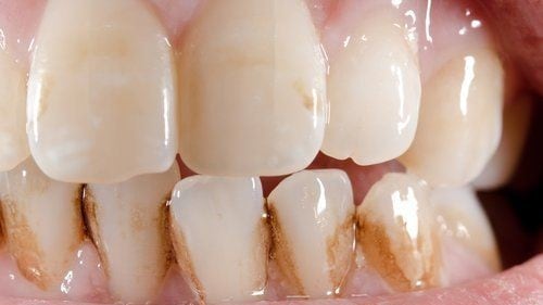 Cepillarse los dientes al menos dos veces al día y usar hilo dental son prácticas esenciales para prevenir la acumulación de sarro y mantener una sonrisa saludable.