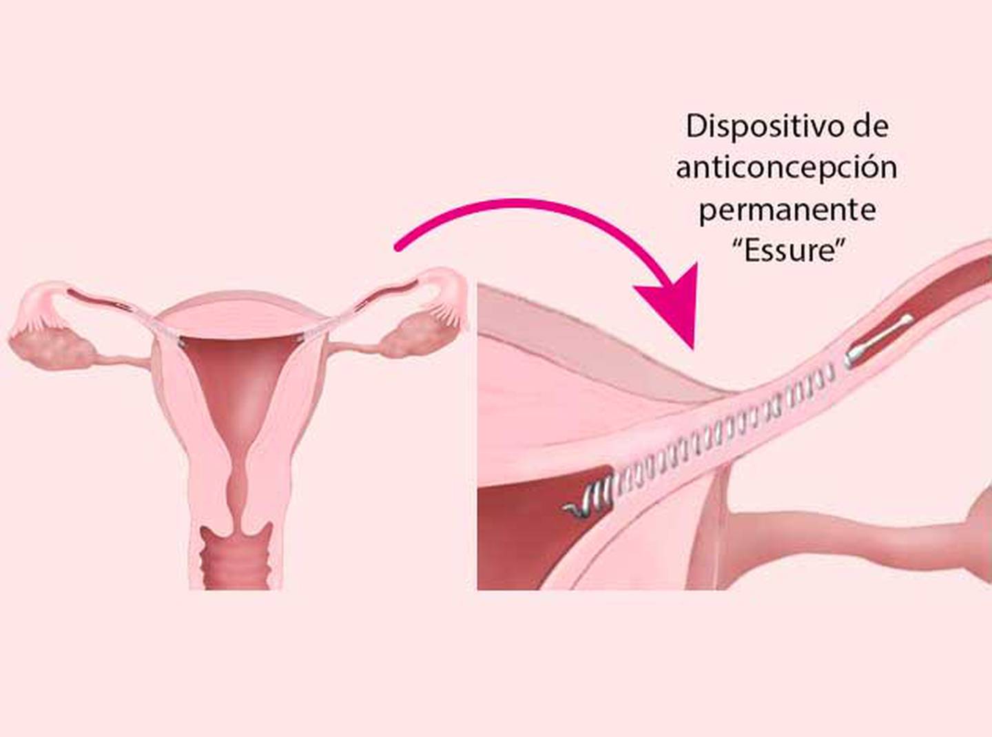 Esterilización Femenina Sin Cirugía Está Disponible En Costa Rica La Nación 2090