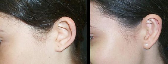 Otoplastia realizada por el cirujano Ronald Pino en la que se cambiaron la posición y tamaño de las orejas. Foto: Cortesía Ronald Pino