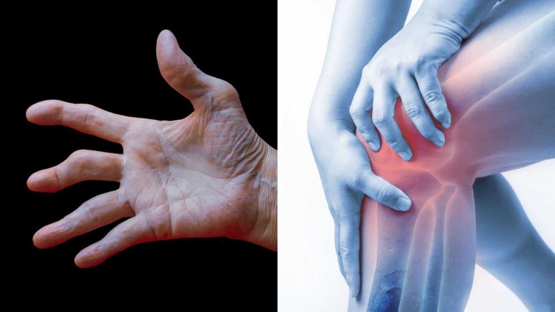 Pacientes con artritis y artrosis suelen experimentar dolor y rigidez en las articulaciones, lo que puede limitar su movilidad y actividades diarias.