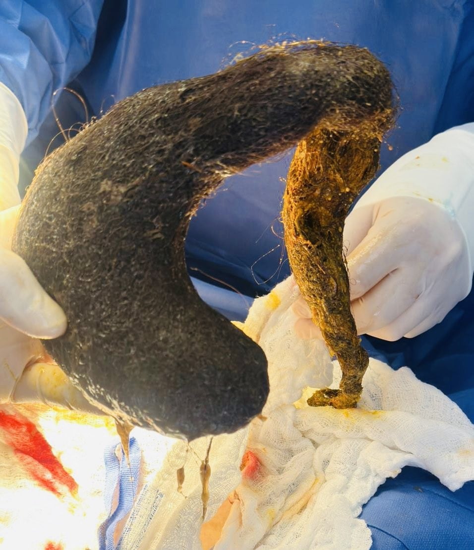Cirujanos en Ecuador extrajeron exitosamente una bola de pelos de 40 centímetros del estómago de una mujer, luego de dos años de síntomas graves.