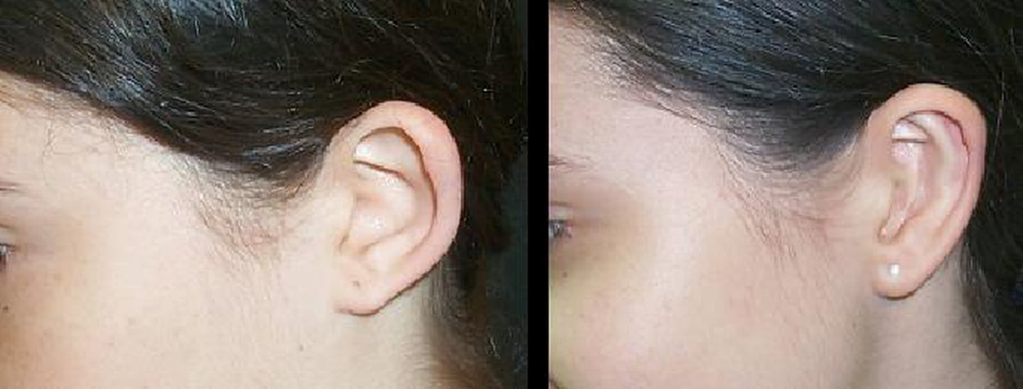 Otoplastia realizada por el cirujano Ronald Pino en la que se cambiaron la posición y tamaño de las orejas. Foto: Cortesía
