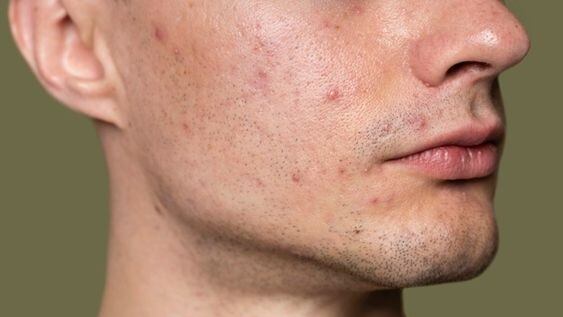 Un nuevo estudio investiga cómo la dieta puede influir en la reducción de los síntomas del acné, ofreciendo nuevas perspectivas para el tratamiento dermatológico.