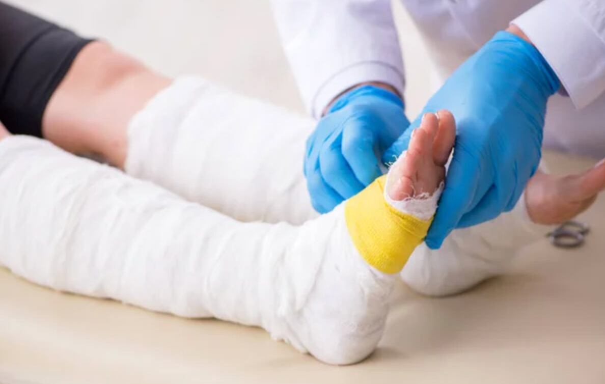 Las quemaduras por bicimotos se dan principalmente en las extremidades inferiores: rodilla, pierna, tobillo, y en ocasiones se combinan con fracturas.
