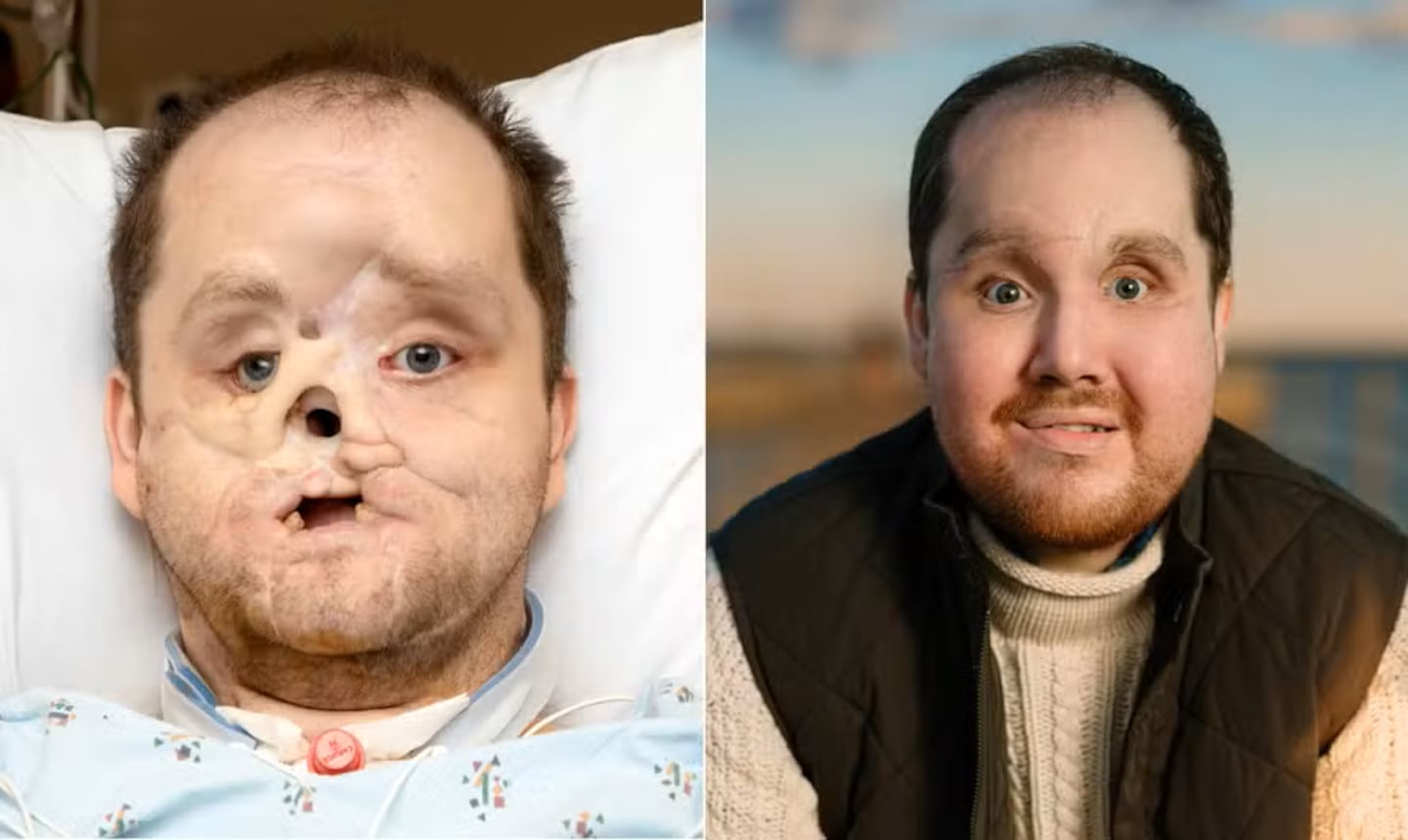 La historia de Derek Pfaff: Un trasplante facial que transformó su vida  tras 10 años de lucha | La Nación